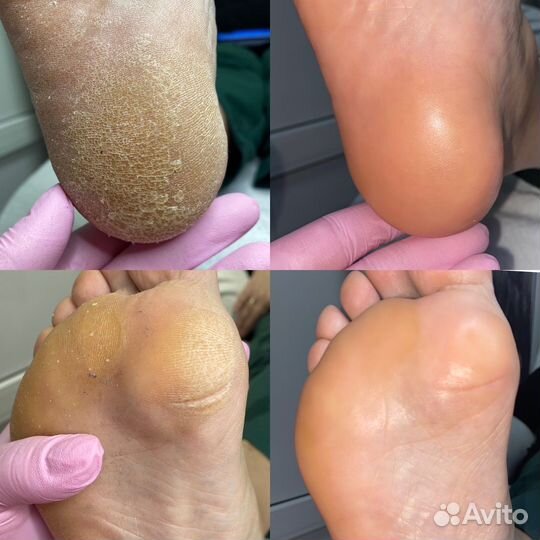 Smart педикюр