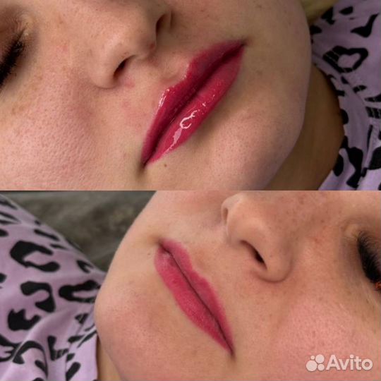 Увеличение губ