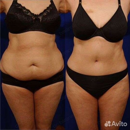 Вакуумный массаж, кавитация, RF