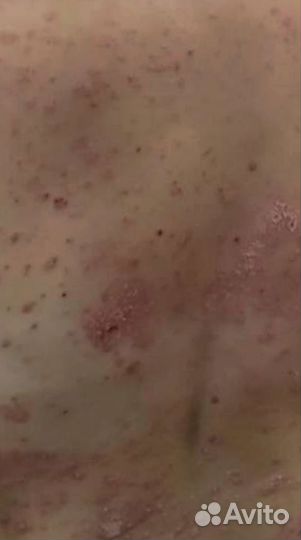 Мазь от псориаза