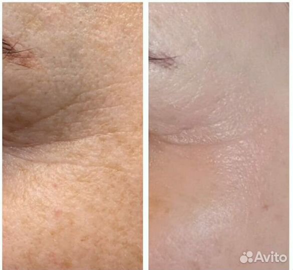 Ультразвуковая чистка лица