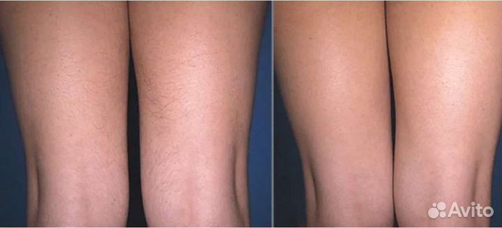 Элос эпиляция, лазерная эпиляция. эпиляция тела