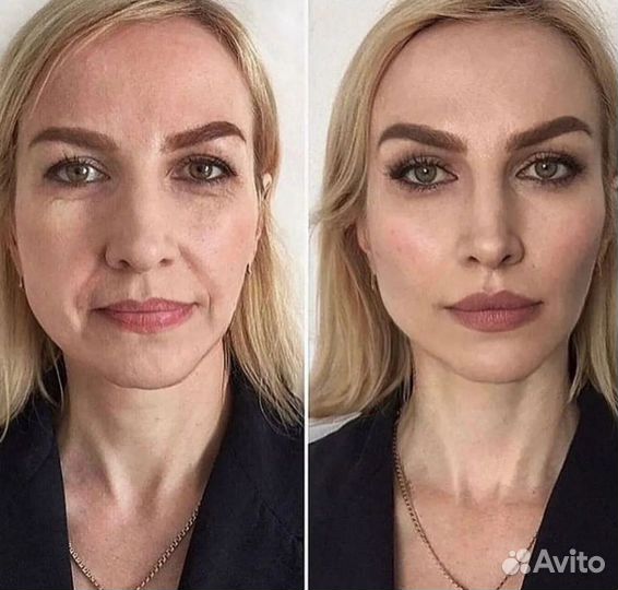 Коктейль Монако + ботокс