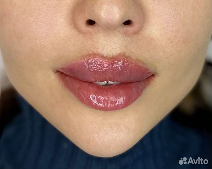 Увеличение губ контурная пластика