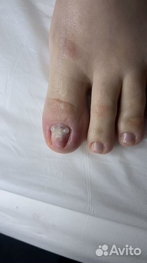 Педикюр, титановые нити, сложные стопы