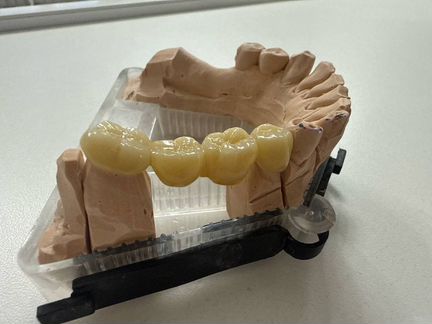 Зубные коронки установка