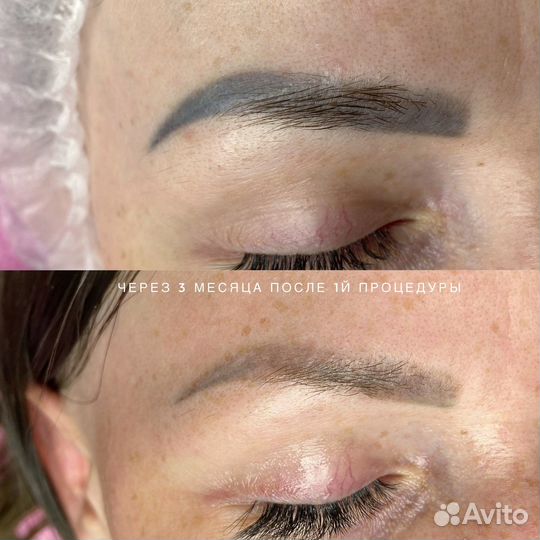 Требуются модели на удаление татуажа