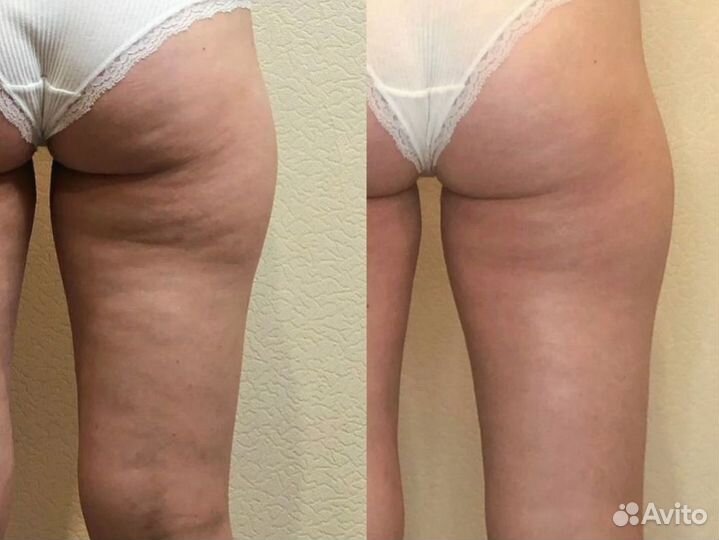 Массаж/Lpg массаж/антицеллюлитный массаж