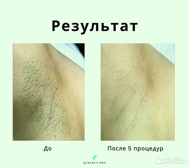 Диодный лазер Люминес Max One 1200 Вт