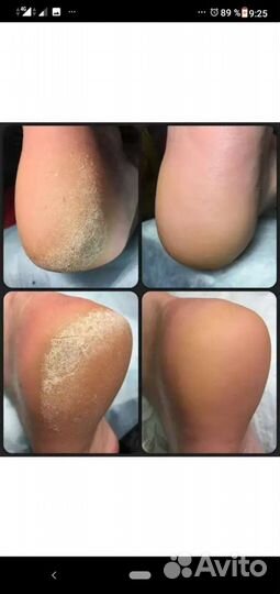 Педикюр любой сложности