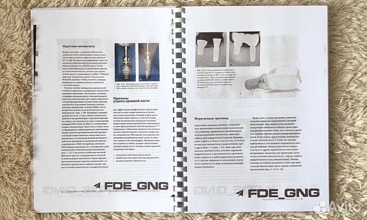 Нулевая утрата кости