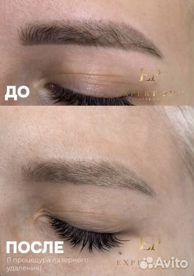 Лазерное удаление тату