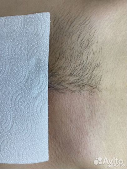 Шугаринг, Депиляция воском