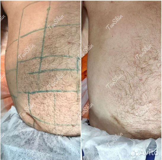 Липосоникс.Коррекция фигуры.Уменьшение объемов