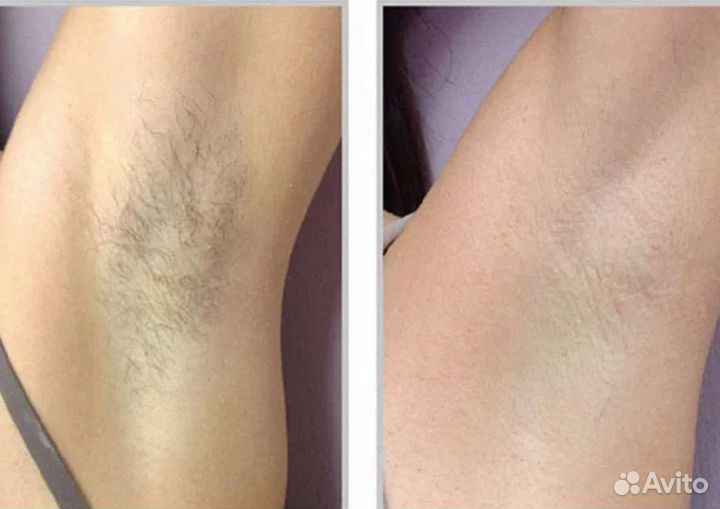 Элос эпиляция, лазерная эпиляция. эпиляция тела