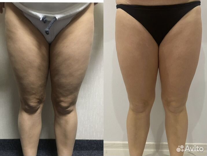 Обучение ручной липосакции