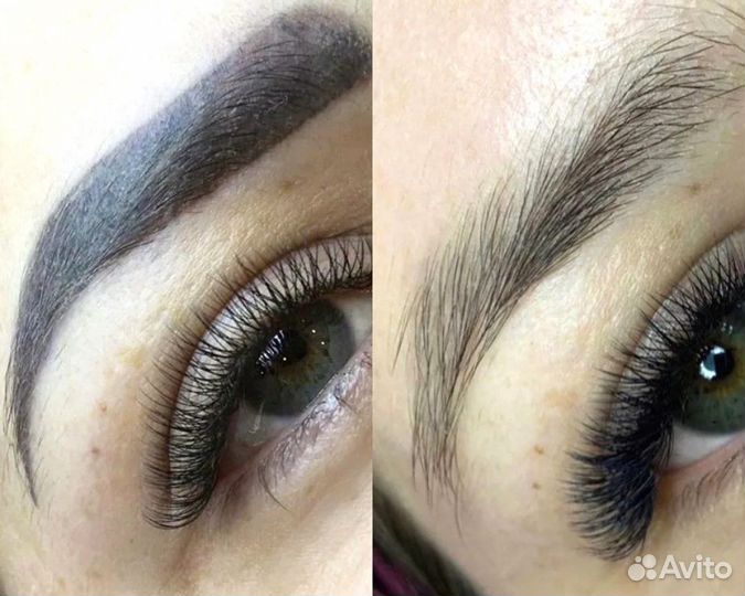 Лазерное удаление тату и татуажа