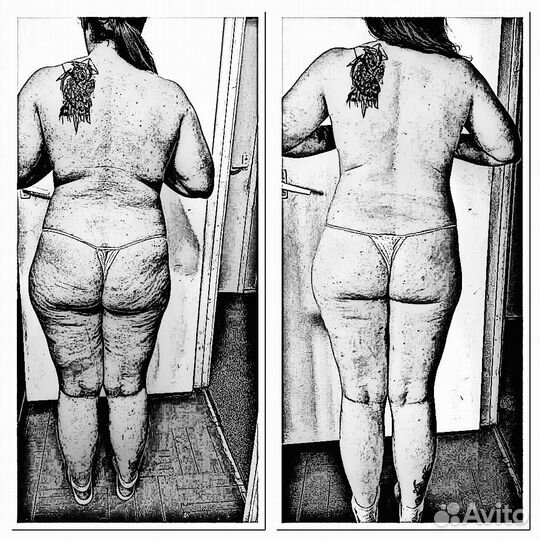 Похудение, коррекция фигуры