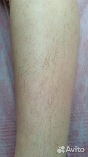 Электроэпиляция: глубокое бикини