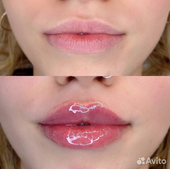 Увеличение губ