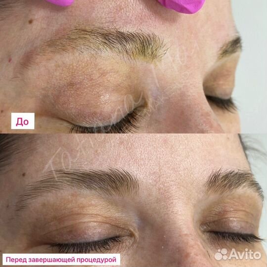 Удаление ремувером татуажа