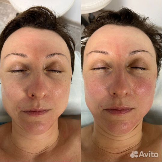 Массаж лица