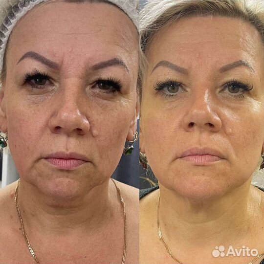 Модель на омоложение лица без уколов