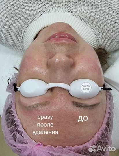 Удаление татуировок, татуажа