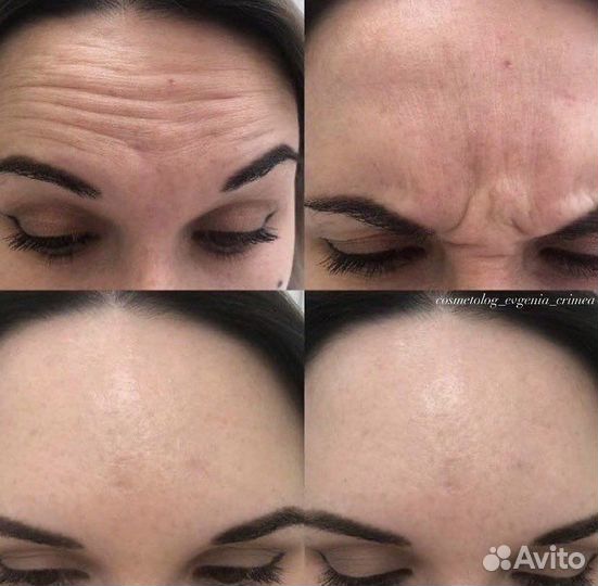 Ботокс для лица