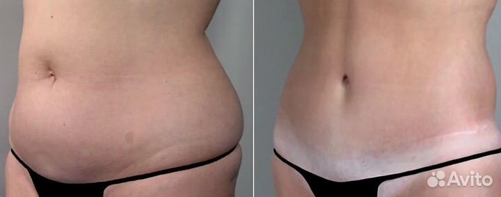 Липосакция без операции
