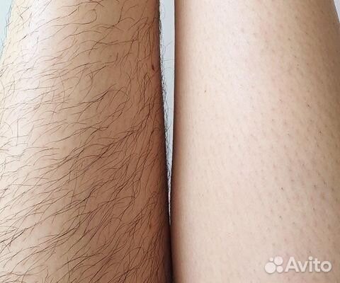 Депиляция воском: подмышки