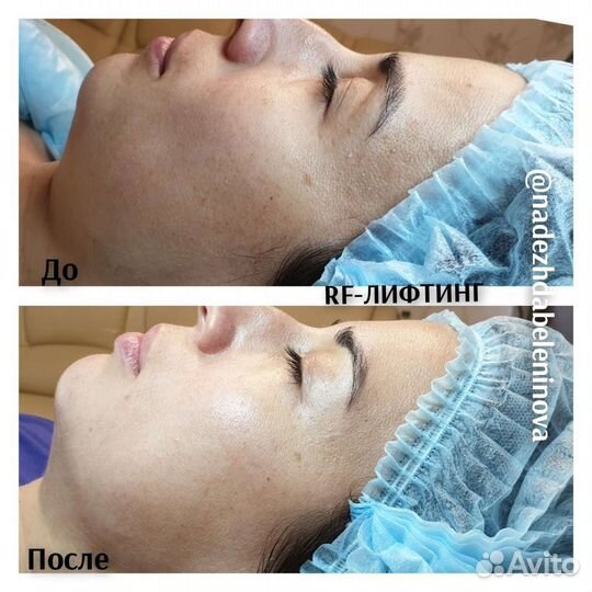 Вакуумный массаж, Кавитация, RF лифтинг