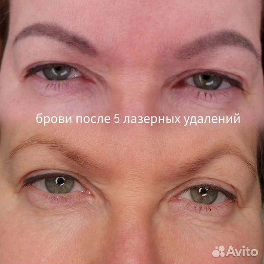 Удаление татуажа.Карбоновый пилинг.Обучение