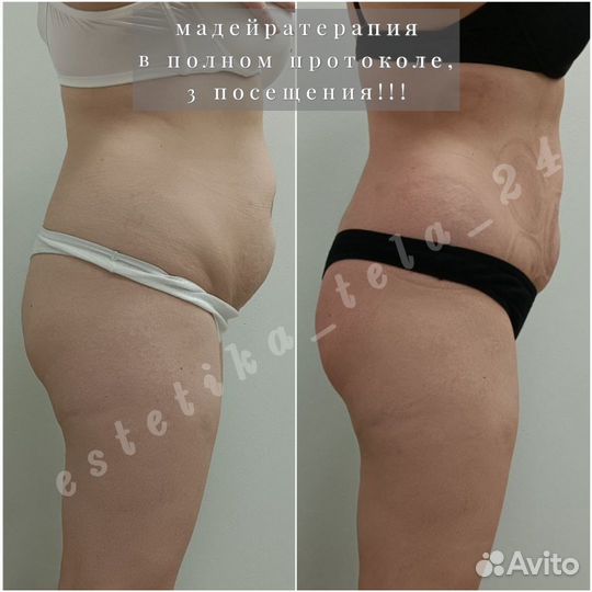 Антицеллюлитный массаж / коррекция фигуры / LPG
