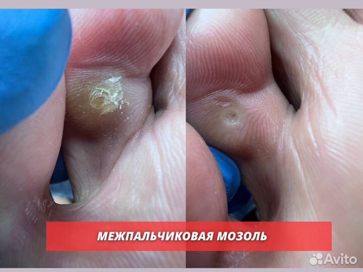 Подолог Лечение грибка Удаление мозолей