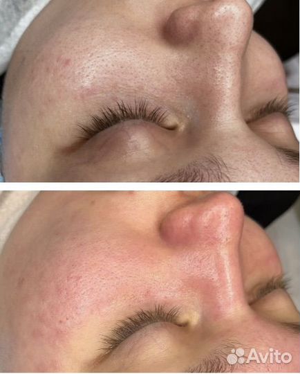 Косметолог чистка лица