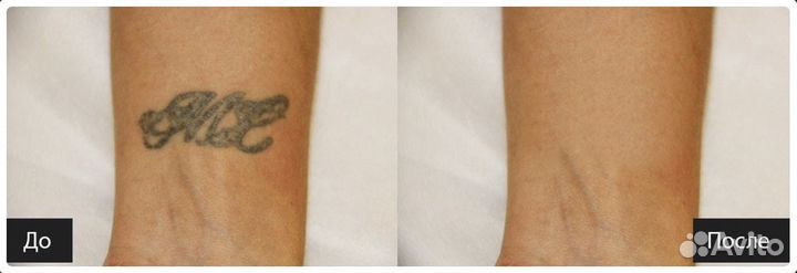 Лазерное удаление тату
