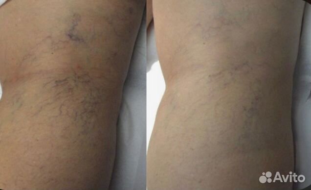 Удаление сосудов (сосудистой сетки)