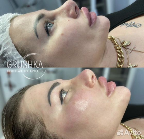 Смас лифтинг ультраформер подтяжка лица