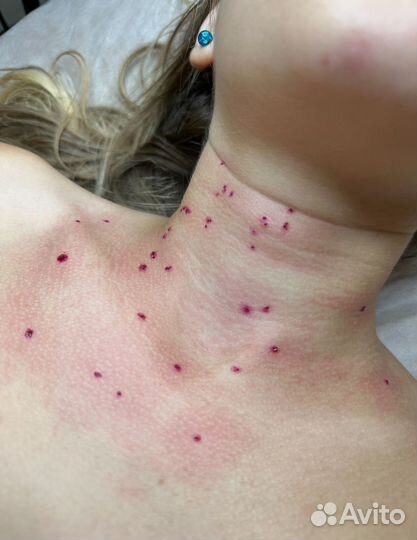 Удаление папиллом