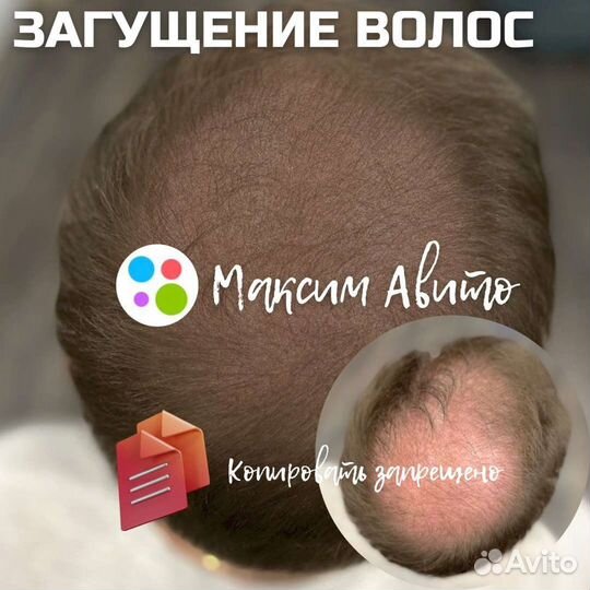 Трихопигментация головы