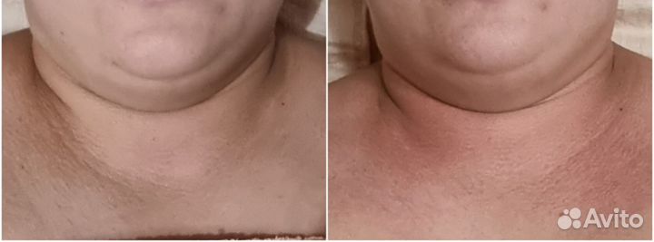 Массаж лица