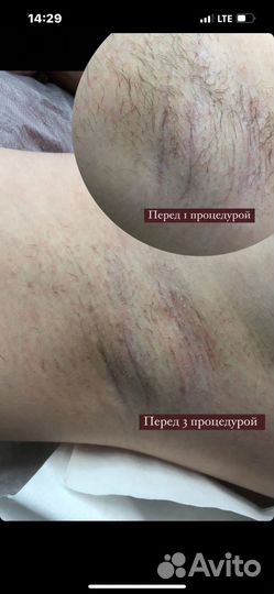 Электроэпиляция