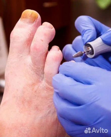 Педикюр(подология)