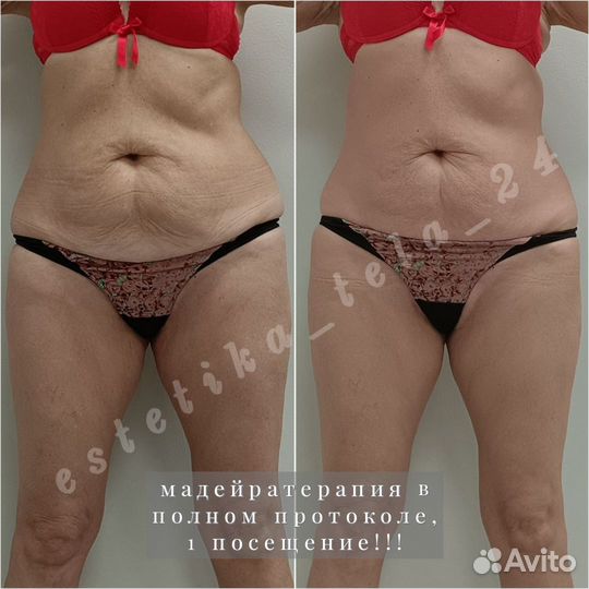 Антицеллюлитный массаж / коррекция фигуры / LPG