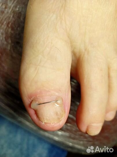 Лечебный педикюр