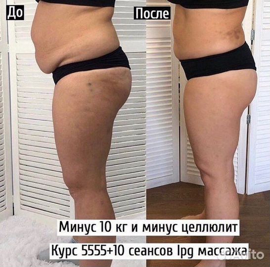 Аппаратный массаж (LPG, 3d и др.)