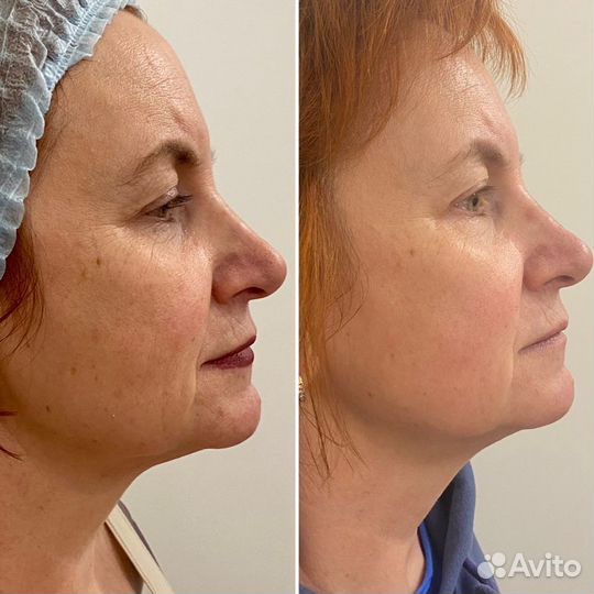 СМАС лифтинг