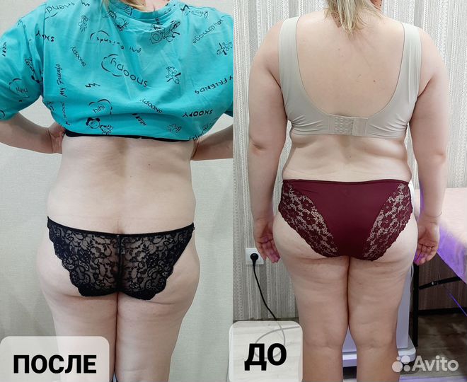 Кавитация, вакум, лазерный липолиз, рф-лифтинг