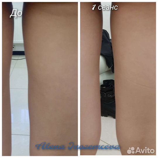 Коррекция фигуры/Кавитация/RF-лифтинг/ Вакуум +RF